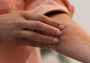 Экзема или атопический дерматит: как избавиться от зуда?