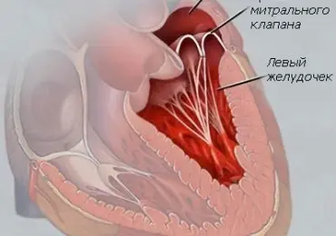 ПМК (Провисание митрального клапана)