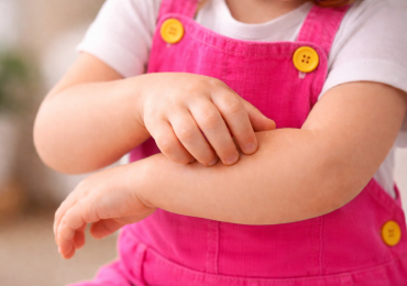 Аллергический дерматит 