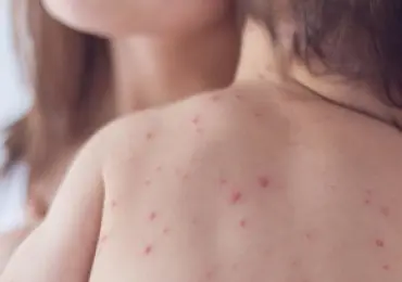 Гнойничковые поражения кожи у детей Гнойничковые поражения кожи у детей